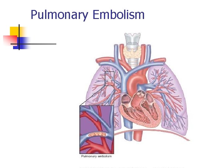 Pulmonary Embolism 