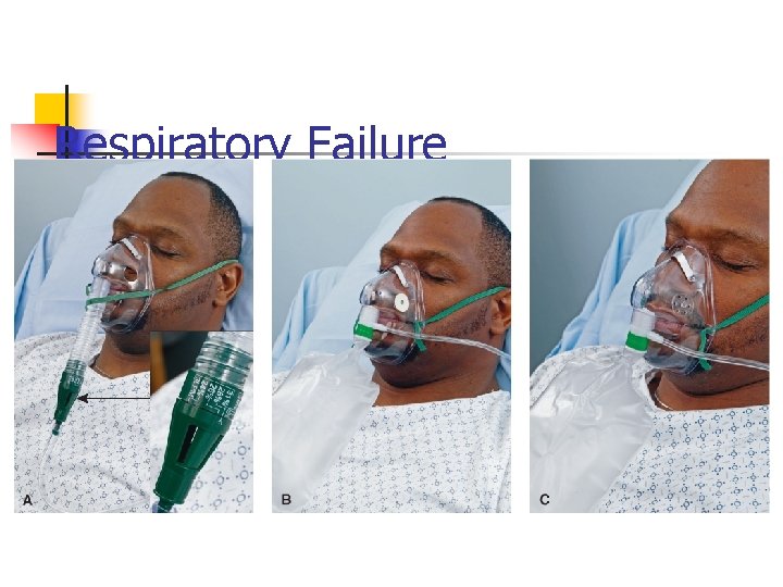 Respiratory Failure 