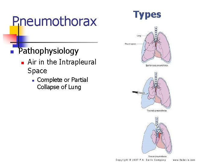 Pneumothorax n Pathophysiology n Air in the Intrapleural Space n Complete or Partial Collapse