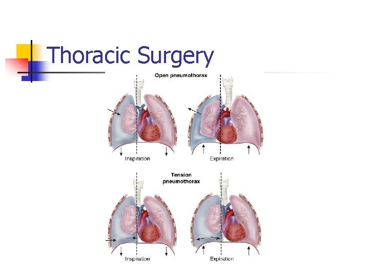 Thoracic Surgery 