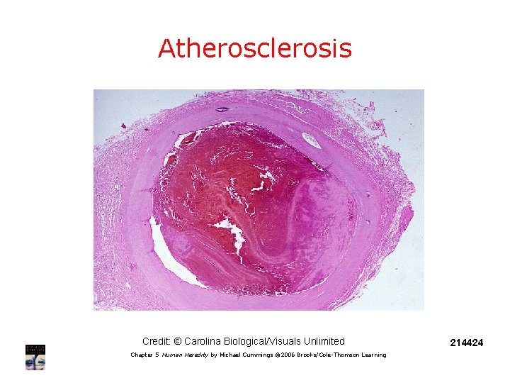 Atherosclerosis Credit: © Carolina Biological/Visuals Unlimited Chapter 5 Human Heredity by Michael Cummings ©