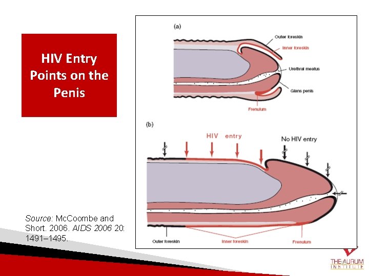 HIV Entry Points on the Penis Source: Mc. Coombe and Short. 2006. AIDS 2006