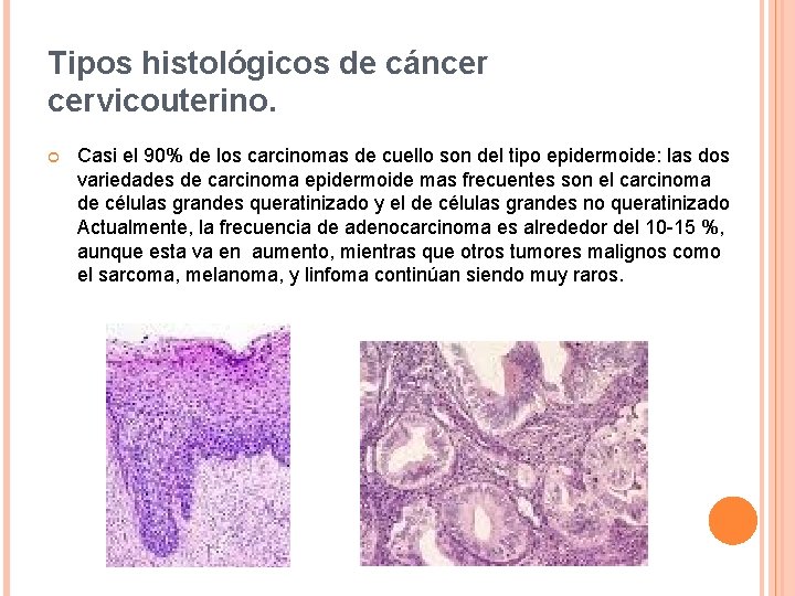 Tipos histológicos de cáncer cervicouterino. Casi el 90% de los carcinomas de cuello son