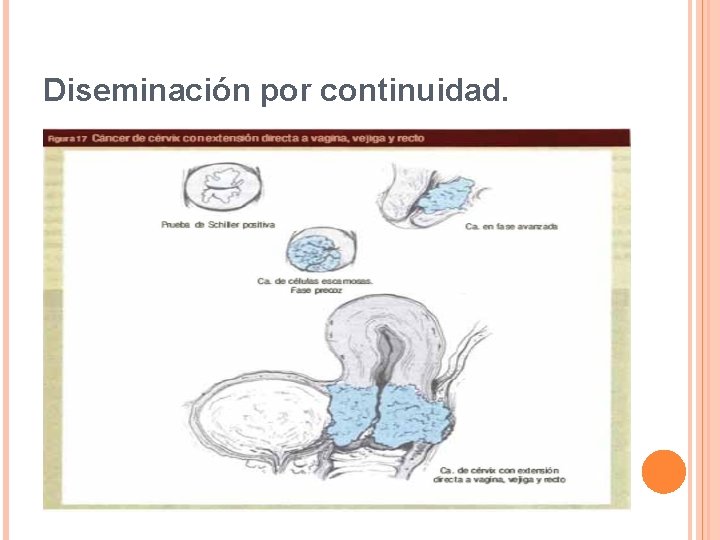 Diseminación por continuidad. 