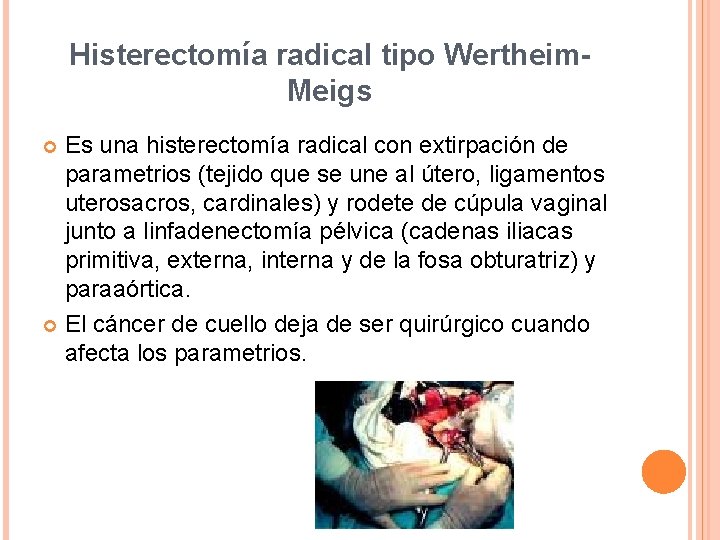 Histerectomía radical tipo Wertheim. Meigs Es una histerectomía radical con extirpación de parametrios (tejido