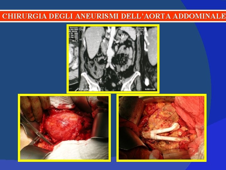 CHIRURGIA DEGLI ANEURISMI DELL’AORTA ADDOMINALE 