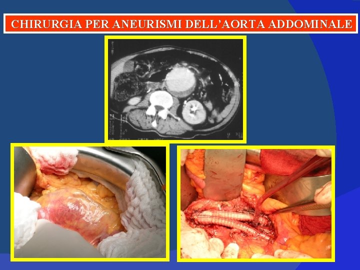 CHIRURGIA PER ANEURISMI DELL’AORTA ADDOMINALE CHIRURGIA PER ANEURISMI DELL’AORTA ADDOMINALE