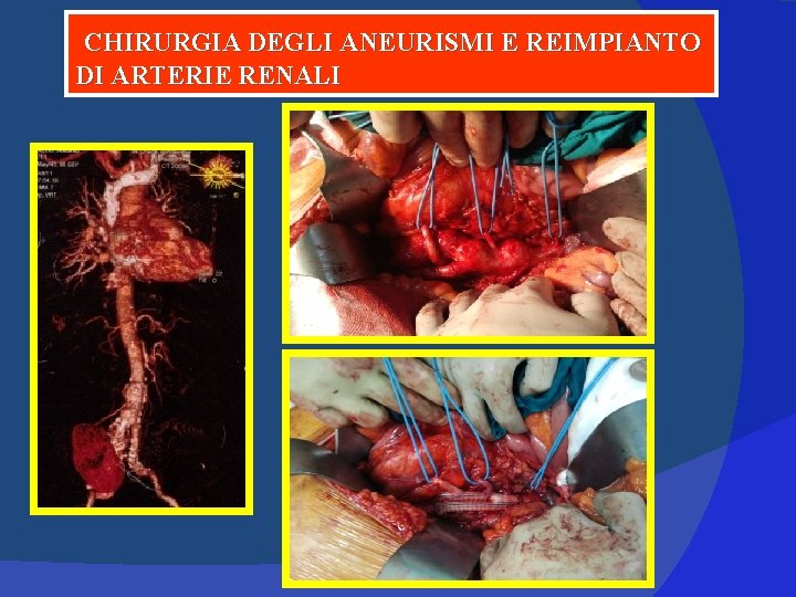 CHIRURGIA DEGLI ANEURISMI E REIMPIANTO DI ARTERIE RENALI 