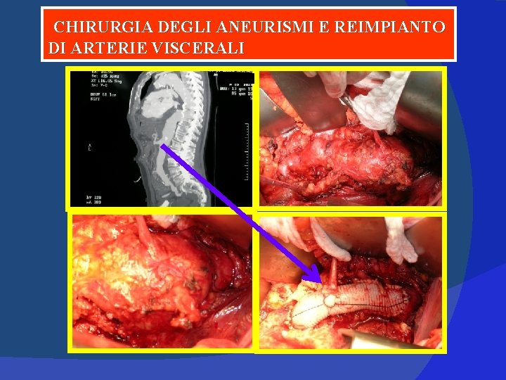 CHIRURGIA DEGLI ANEURISMI E REIMPIANTO DI ARTERIE VISCERALI 