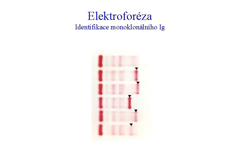 Elektroforéza Identifikace monoklonálního Ig 