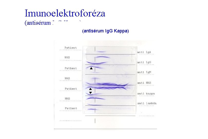 Imunoelektroforéza (antisérum Ig. G Kappa) 