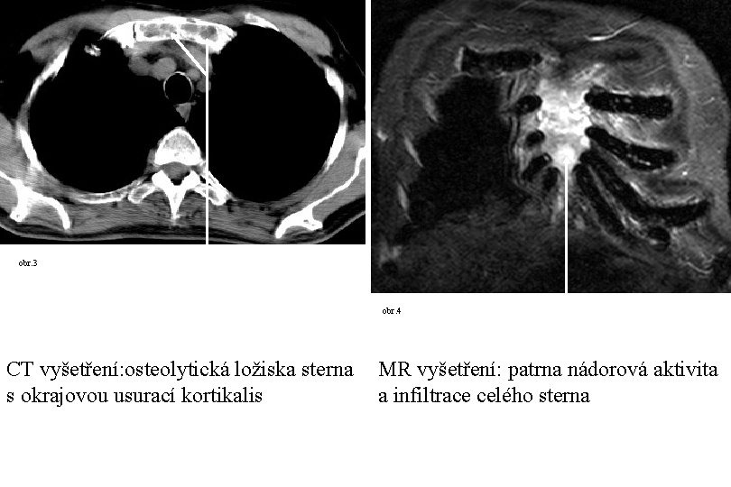 obr. 3 obr. 4 CT vyšetření: osteolytická ložiska sterna s okrajovou usurací kortikalis MR