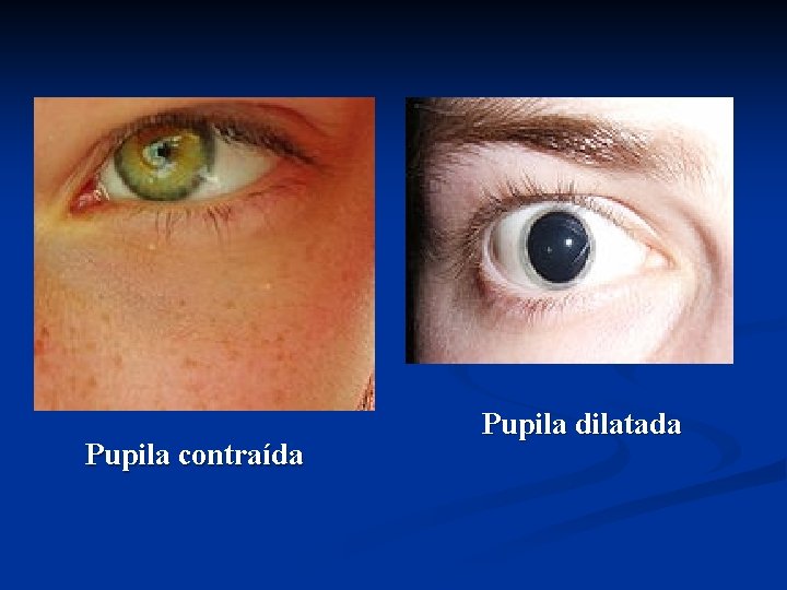 Pupila contraída Pupila dilatada 