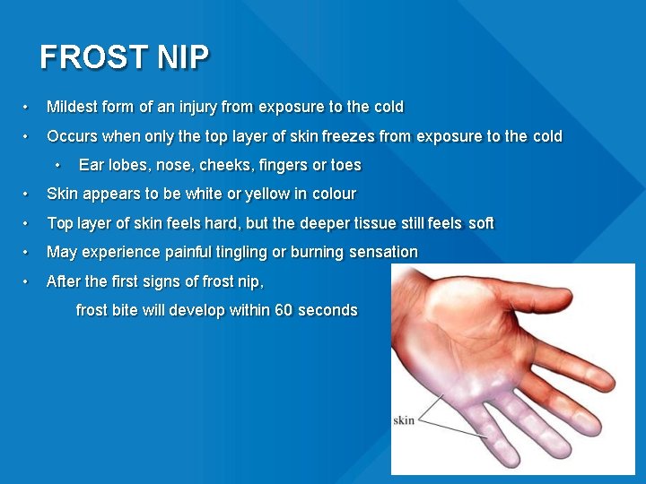 FROST NIP • Mildest form of an injury from exposure to the cold •