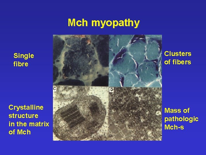 Mch myopathy Single fibre Crystalline structure in the matrix of Mch Clusters of fibers