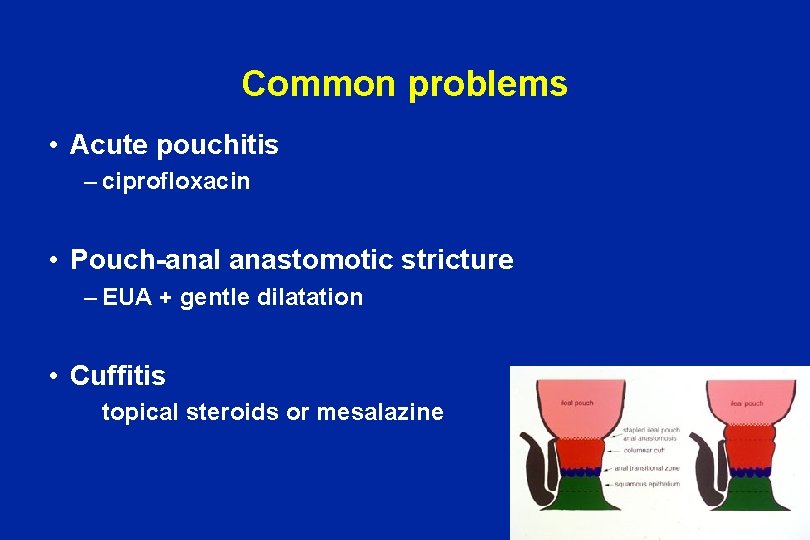 Common problems • Acute pouchitis – ciprofloxacin • Pouch-anal anastomotic stricture – EUA +