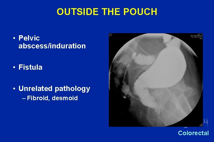 OUTSIDE THE POUCH • Pelvic abscess/induration • Fistula • Unrelated pathology – Fibroid, desmoid