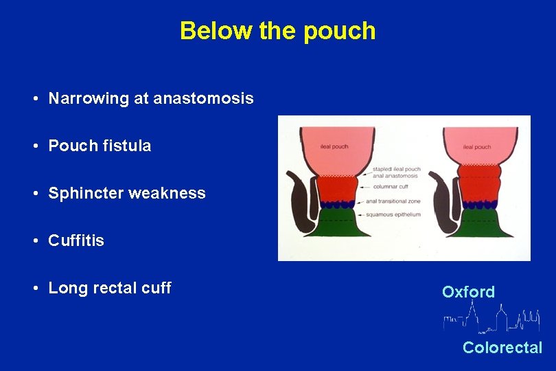 Below the pouch • Narrowing at anastomosis • Pouch fistula • Sphincter weakness •