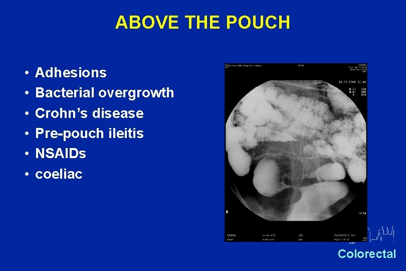 ABOVE THE POUCH • • • Adhesions Bacterial overgrowth Crohn’s disease Pre-pouch ileitis NSAIDs