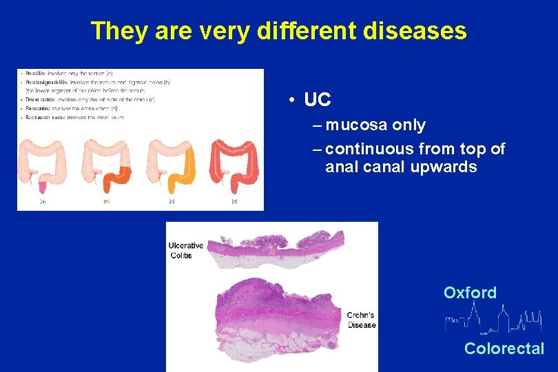 They are very different diseases • UC – mucosa only – continuous from top