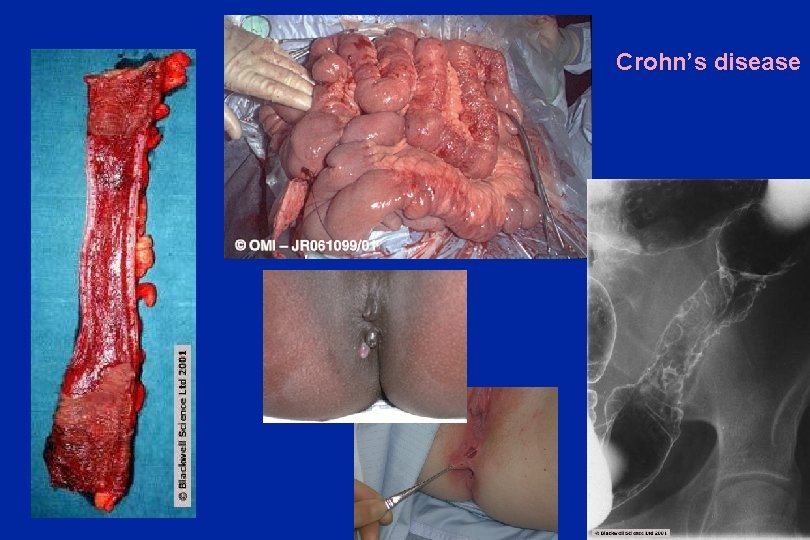 Crohn’s disease Oxford Colorectal 