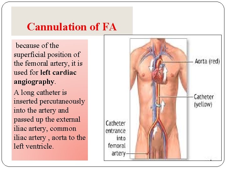 Cannulation of FA because of the superficial position of the femoral artery, it is Cannulation of FA because of the superficial position of the femoral artery, it is