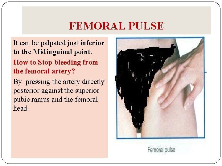 FEMORAL PULSE It can be palpated just inferior to the Midinguinal point. How to FEMORAL PULSE It can be palpated just inferior to the Midinguinal point. How to