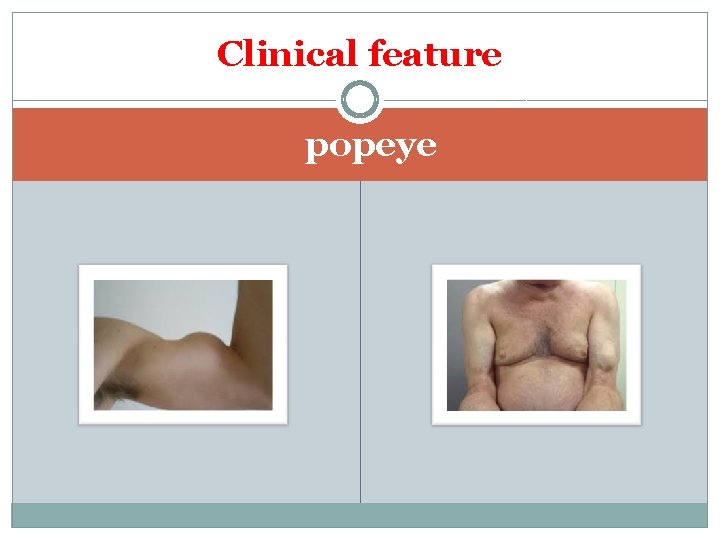 Clinical feature popeye 