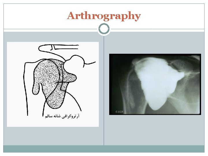 Arthrography 