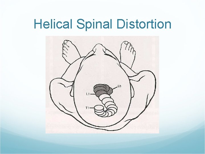 Helical Spinal Distortion 