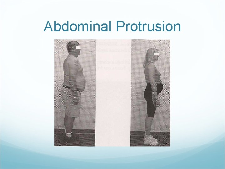 Abdominal Protrusion 