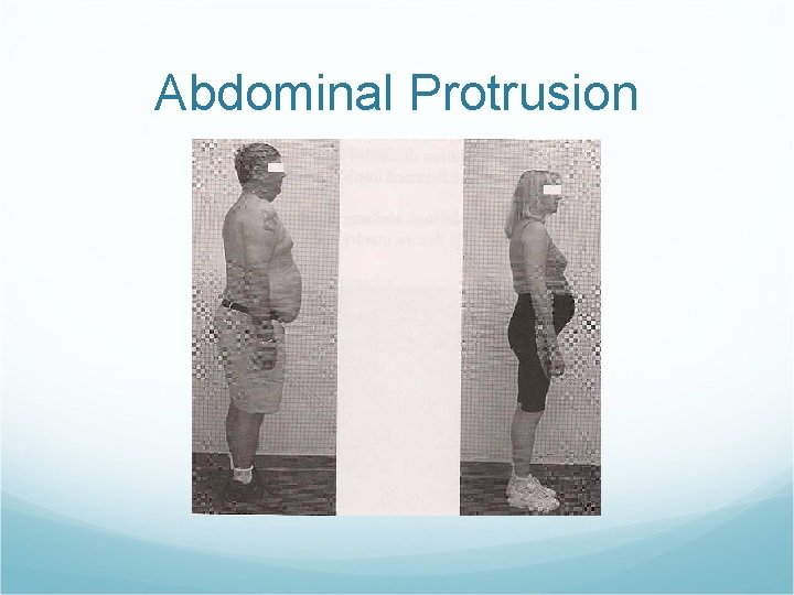 Abdominal Protrusion Abdominal Protrusion
