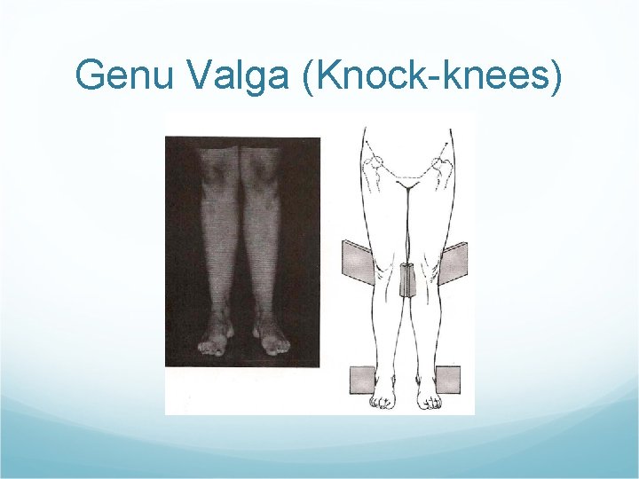 Genu Valga (Knock-knees) Genu Valga (Knock-knees)