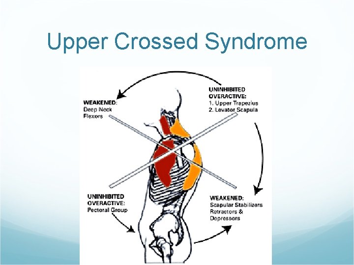 Upper Crossed Syndrome Upper Crossed Syndrome