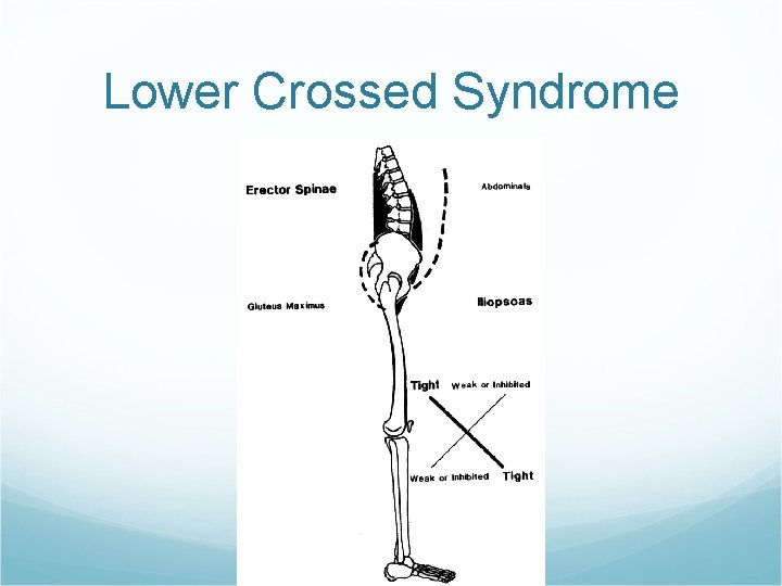 Lower Crossed Syndrome Lower Crossed Syndrome