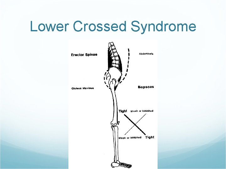 Lower Crossed Syndrome 