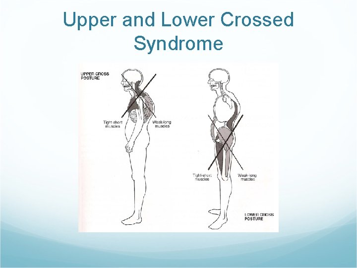 Upper and Lower Crossed Syndrome 