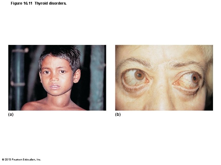 Figure 16. 11 Thyroid disorders. © 2013 Pearson Education, Inc. 