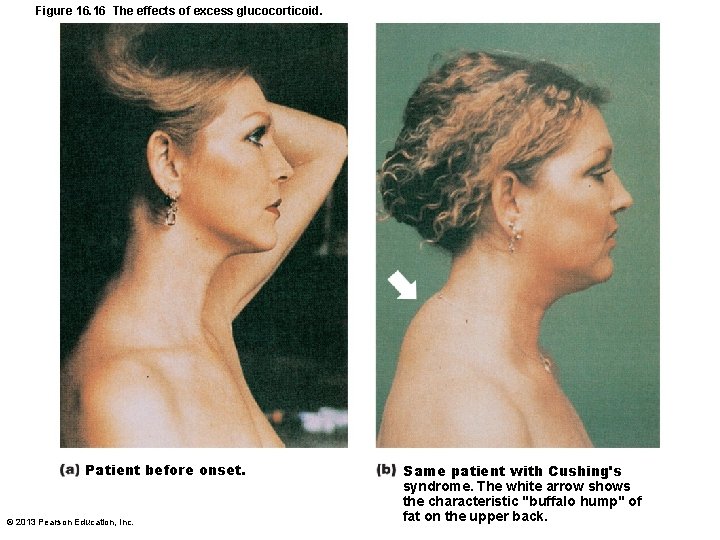 Figure 16. 16 The effects of excess glucocorticoid. Patient before onset. © 2013 Pearson