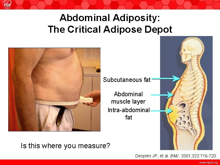 Abdominal Adiposity: The Critical Adipose Depot Subcutaneous fat Abdominal muscle layer Intra-abdominal fat Is