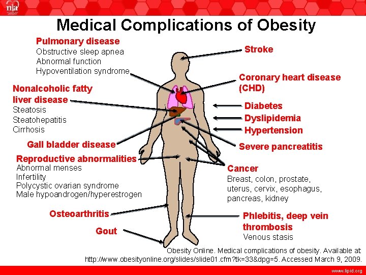Medical Complications of Obesity Pulmonary disease Obstructive sleep apnea Abnormal function Hypoventilation syndrome Nonalcoholic