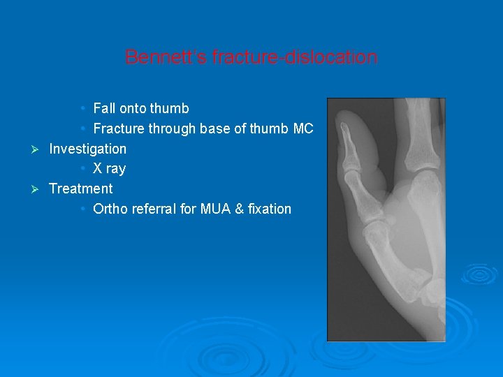 Bennett’s fracture-dislocation • Fall onto thumb • Fracture through base of thumb MC Ø