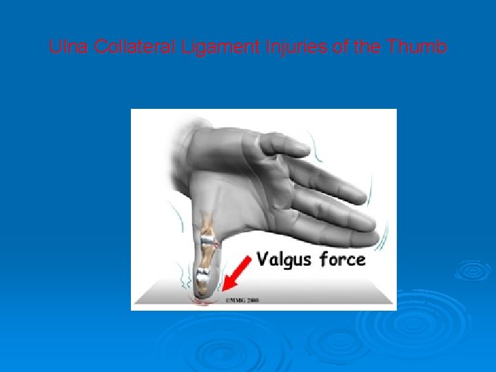 Ulna Collateral Ligament Injuries of the Thumb 