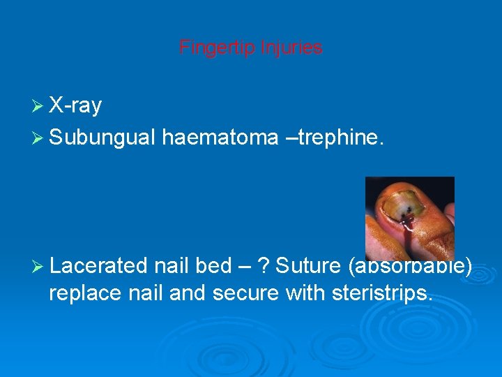 Fingertip Injuries Ø X-ray Ø Subungual haematoma –trephine. Ø Lacerated nail bed – ?