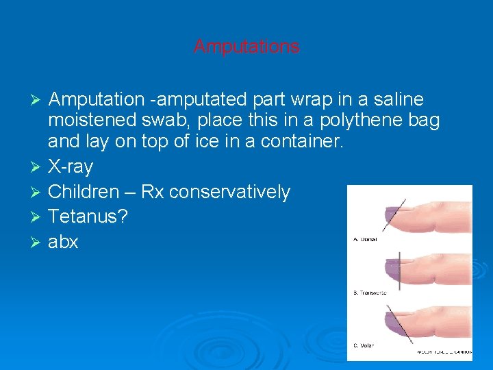 Amputations Amputation -amputated part wrap in a saline moistened swab, place this in a
