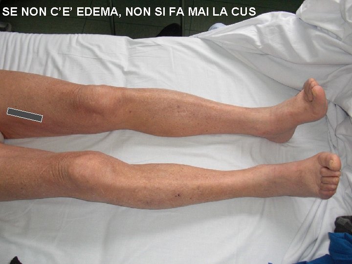 SE NON C’E’ EDEMA, NON SI FA MAI LA CUS 