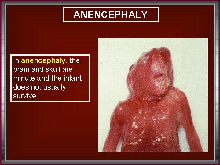 ANENCEPHALY In anencephaly, the brain and skull are minute and the infant does not