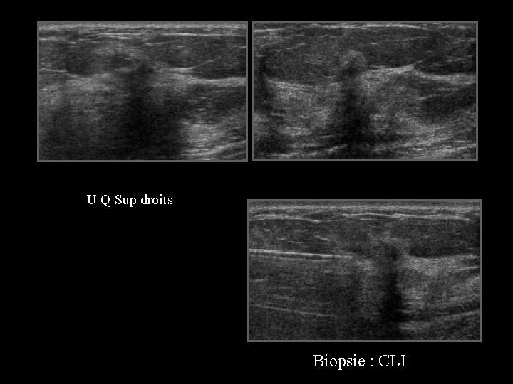 U Q Sup droits Biopsie : CLI 