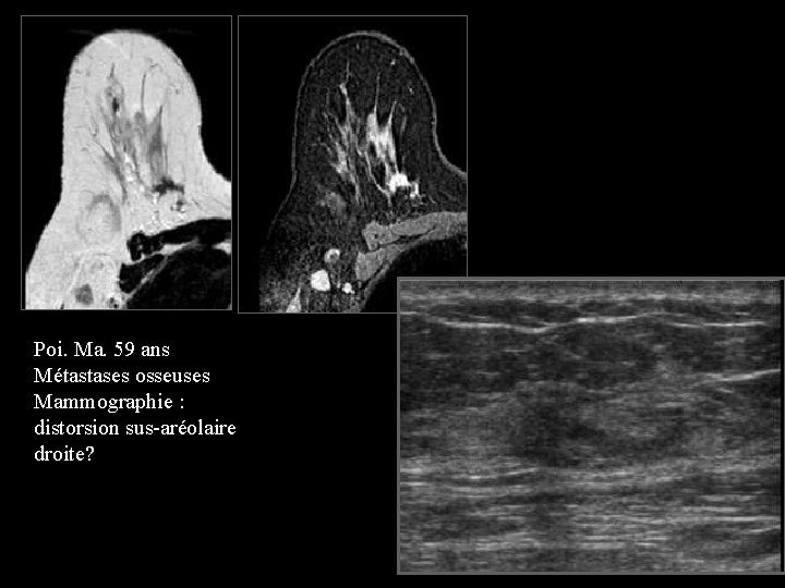 Poi. Ma. 59 ans Métastases osseuses Mammographie : distorsion sus-aréolaire droite? 