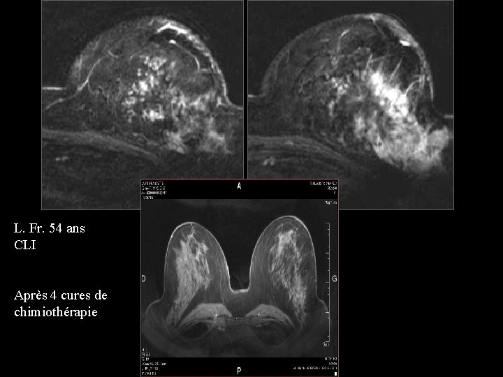 L. Fr. 54 ans CLI Après 4 cures de chimiothérapie 